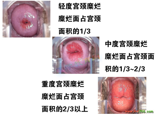宫颈糜烂的表现症状