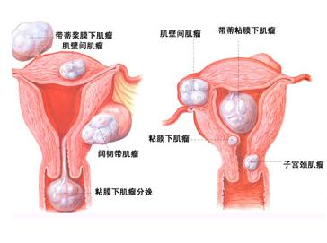 肌瘤示意图